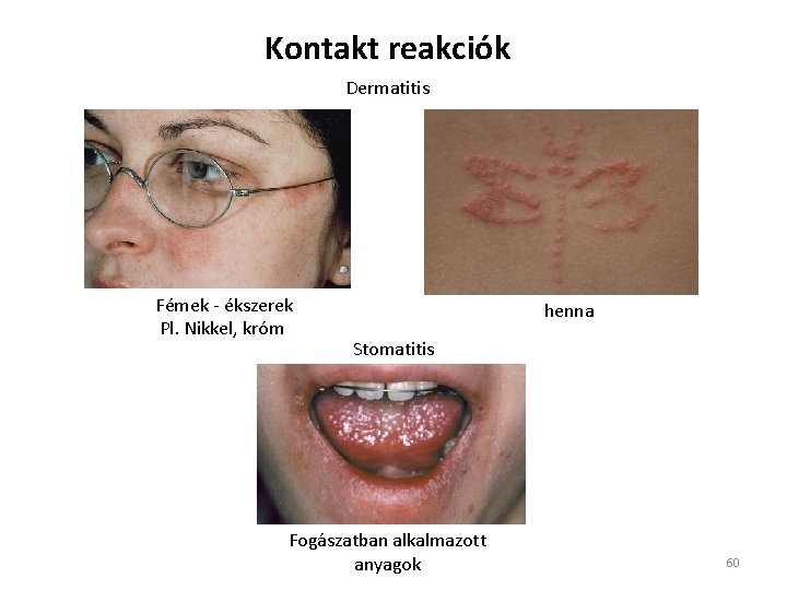 Kontakt reakciók Dermatitis Fémek - ékszerek Pl. Nikkel, króm henna Stomatitis Fogászatban alkalmazott anyagok