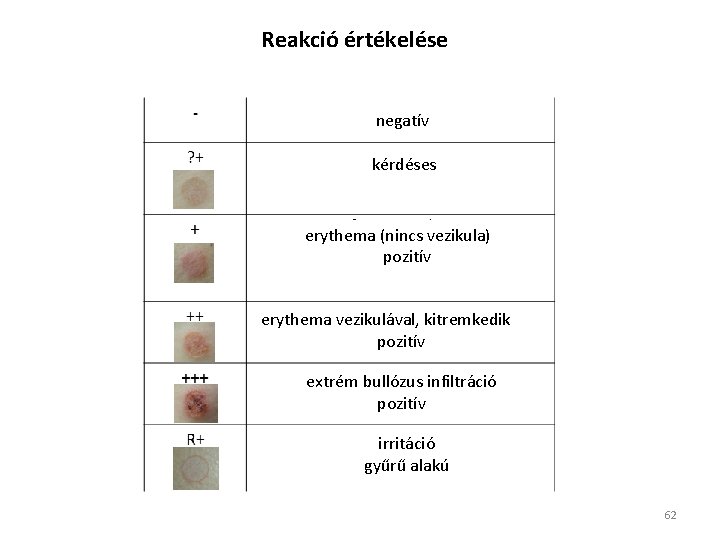 Reakció értékelése negatív kérdéses erythema (nincs vezikula) pozitív erythema vezikulával, kitremkedik pozitív extrém bullózus