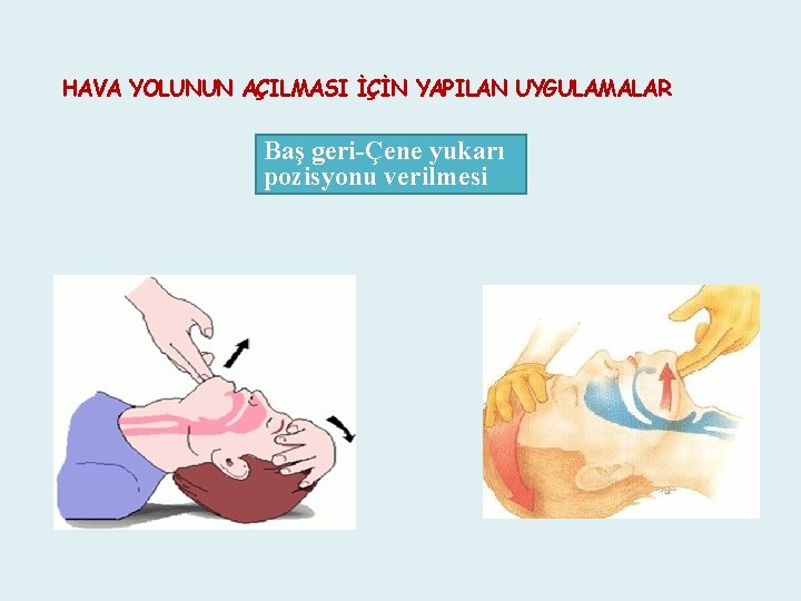 HAVA YOLUNUN AÇILMASI İÇİN YAPILAN UYGULAMALAR Baş geri-Çene yukarı pozisyonu verilmesi 