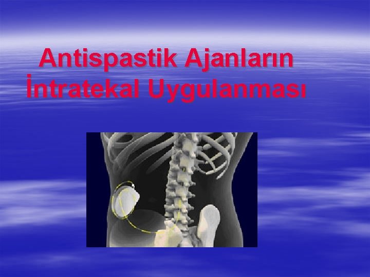 Antispastik Ajanların İntratekal Uygulanması 