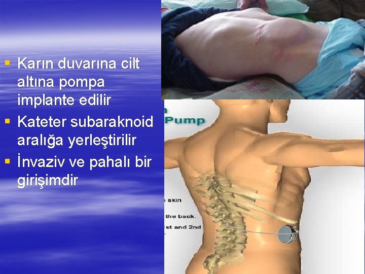 § Karın duvarına cilt altına pompa implante edilir § Kateter subaraknoid aralığa yerleştirilir §