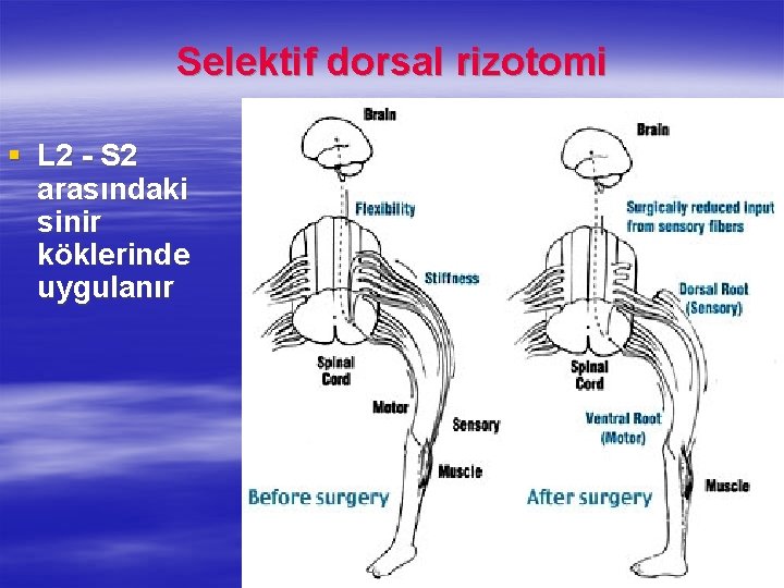 Selektif dorsal rizotomi § L 2 - S 2 arasındaki sinir köklerinde uygulanır 