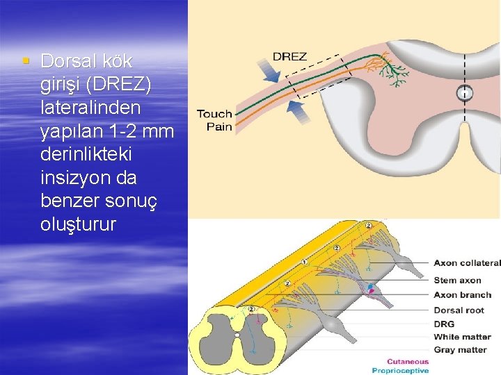 § Dorsal kök girişi (DREZ) lateralinden yapılan 1 -2 mm derinlikteki insizyon da benzer