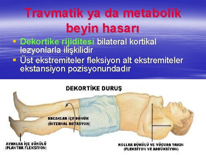 Travmatik ya da metabolik beyin hasarı § Dekortike rijiditesi bilateral kortikal lezyonlarla ilişkilidir §