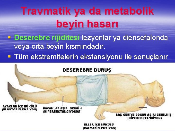 Travmatik ya da metabolik beyin hasarı § Deserebre rijiditesi lezyonlar ya diensefalonda veya orta