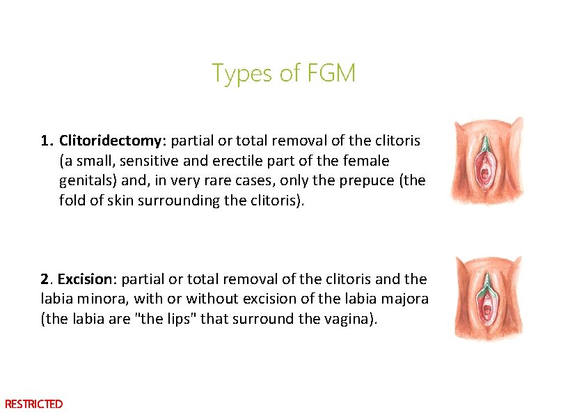 Types of FGM 1. Clitoridectomy: partial or total removal of the clitoris (a small,