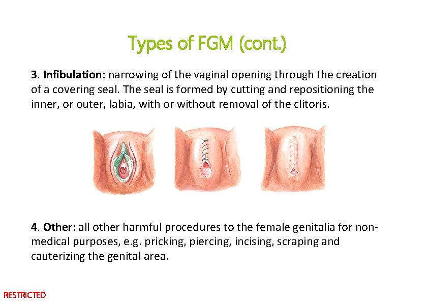 Types of FGM (cont. ) 3. Infibulation: narrowing of the vaginal opening through the