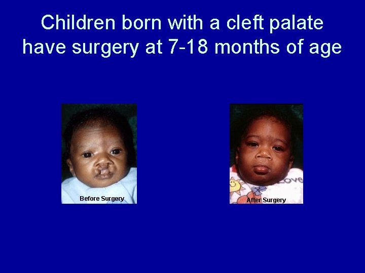 Children born with a cleft palate have surgery at 7 -18 months of age