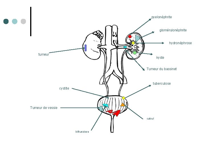 pyelonéphrite glomérulonéphrite … hydronéphrose tumeur kyste Tumeur du bassinet tuberculose cystite Tumeur de vessie