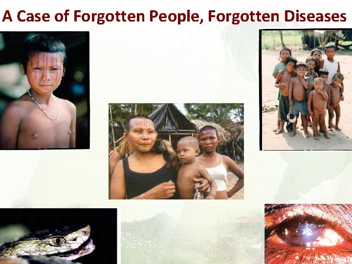 A Case of Forgotten People, Forgotten Diseases 