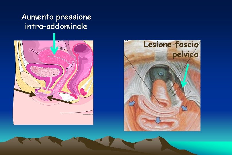 Aumento pressione intra-addominale Lesione fascia pelvica 