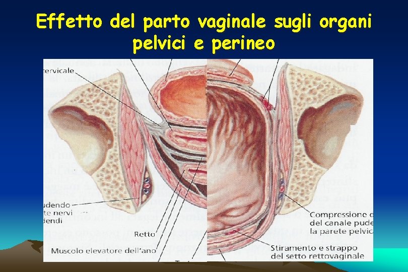 Effetto del parto vaginale sugli organi pelvici e perineo 