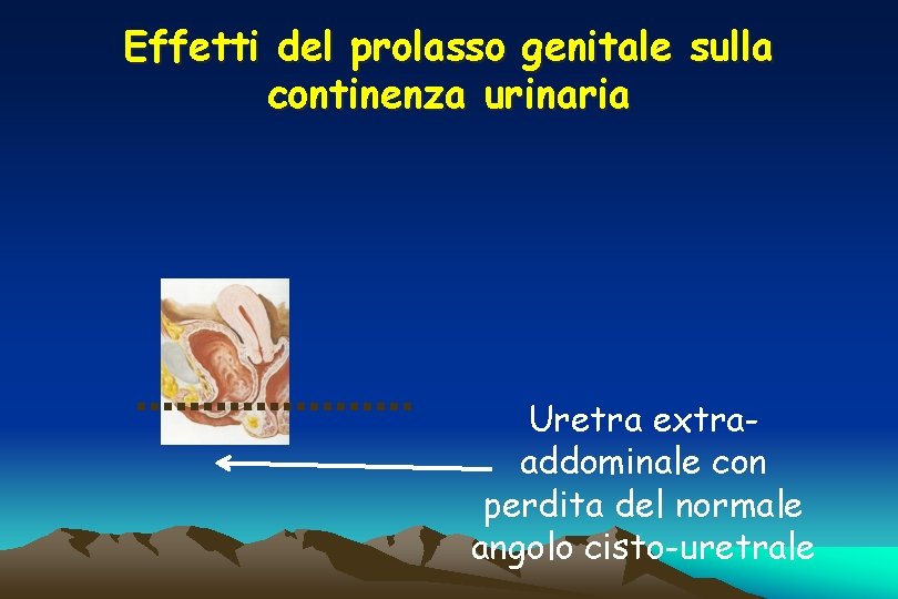 Effetti del prolasso genitale sulla continenza urinaria Uretra extraaddominale con perdita del normale angolo