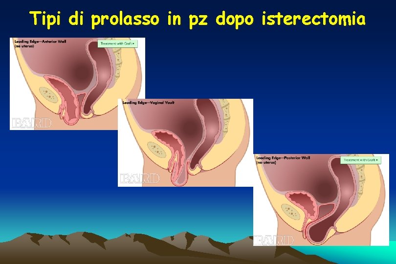 Tipi di prolasso in pz dopo isterectomia Tipi di prolasso in pz dopo isterectomia