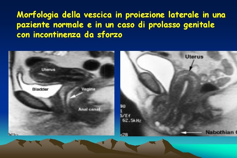 Morfologia della vescica in proiezione laterale in una paziente normale e in un caso