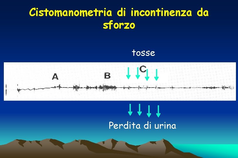 Cistomanometria di incontinenza da sforzo tosse Perdita di urina Cistomanometria di incontinenza da sforzo tosse Perdita di urina