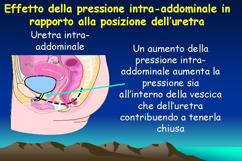 Effetto della pressione intra-addominale in rapporto alla posizione dell’uretra Uretra intraaddominale Un aumento della
