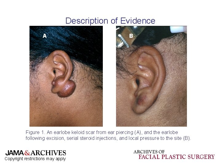 Description of Evidence A B Figure 1. An earlobe keloid scar from ear piercing