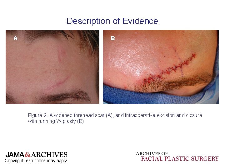 Description of Evidence A B Figure 2. A widened forehead scar (A), and intraoperative