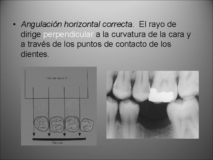  • Angulación horizontal correcta. El rayo de dirige perpendicular a la curvatura de