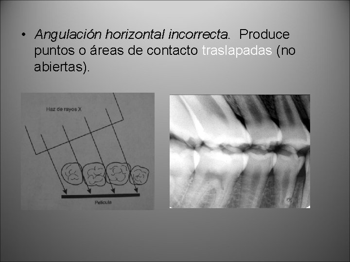  • Angulación horizontal incorrecta. Produce puntos o áreas de contacto traslapadas (no abiertas).