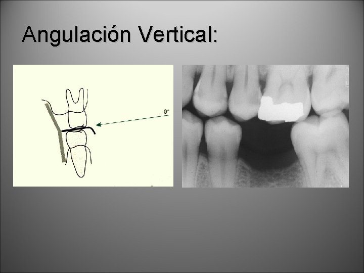 Angulación Vertical: 