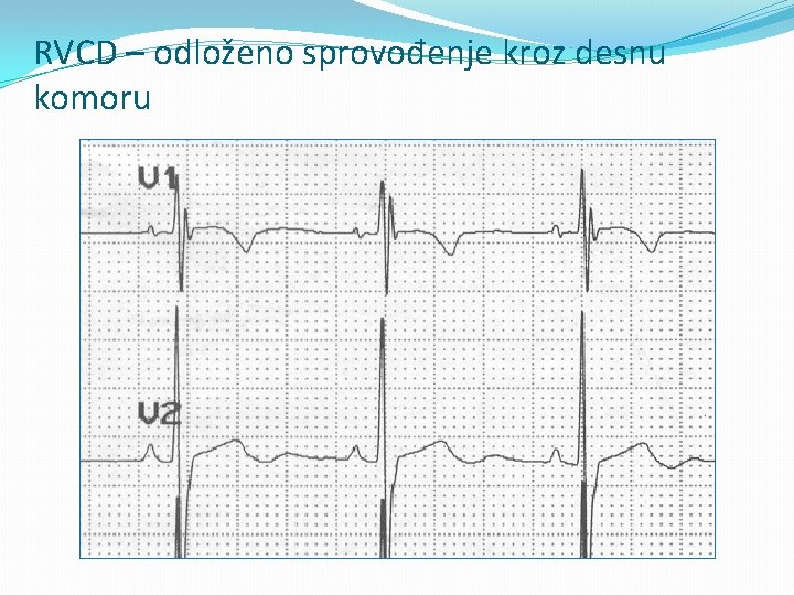 RVCD – odloženo sprovođenje kroz desnu komoru 