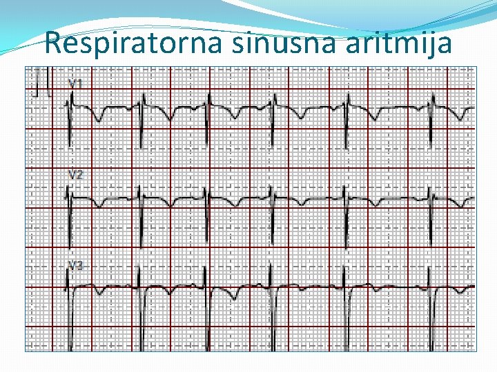 Respiratorna sinusna aritmija 