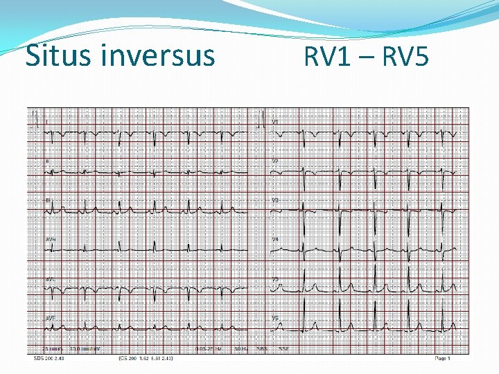 Situs inversus RV 1 – RV 5 