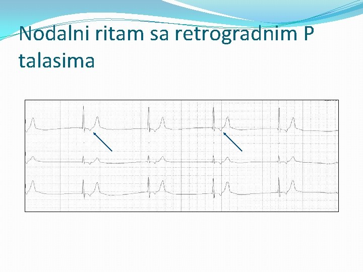 Nodalni ritam sa retrogradnim P talasima 