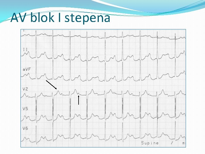 AV blok I stepena 