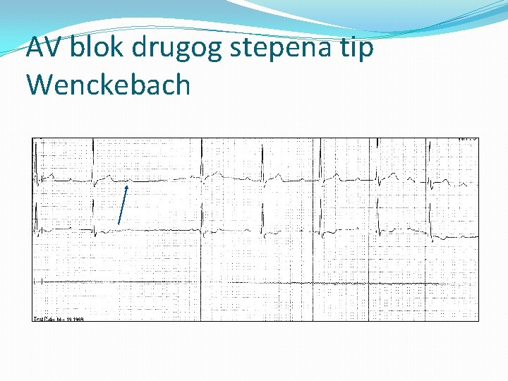 AV blok drugog stepena tip Wenckebach 