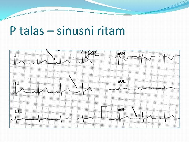 P talas – sinusni ritam 