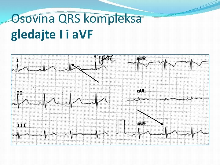 Osovina QRS kompleksa gledajte I i a. VF 