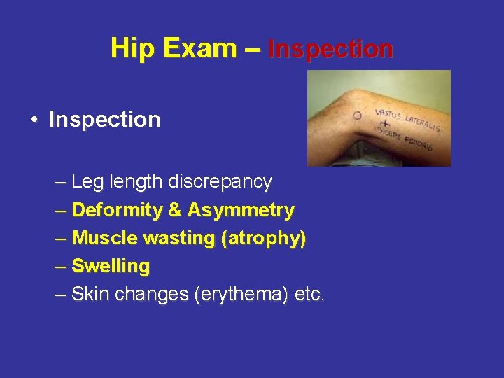 Hip Exam – Inspection • Inspection – Leg length discrepancy – Deformity & Asymmetry