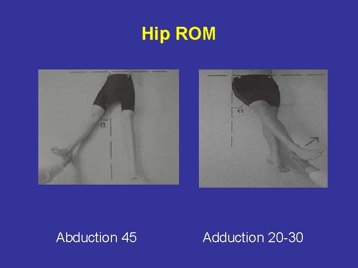 Hip ROM Abduction 45 Adduction 20 -30 