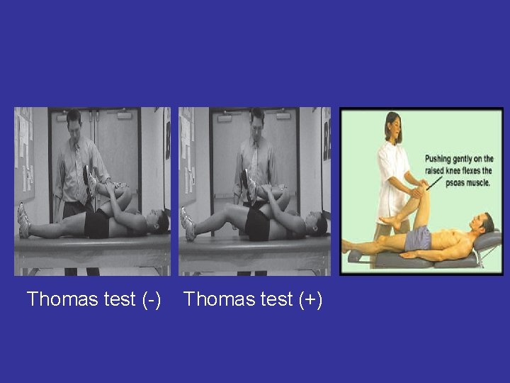 Thomas test (-) Thomas test (+) 