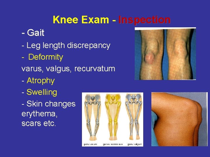 Knee Exam - Inspection - Gait - Leg length discrepancy - Deformity varus, valgus,