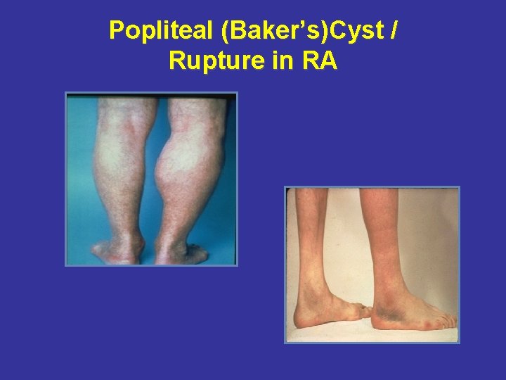 Popliteal (Baker’s)Cyst / Rupture in RA 