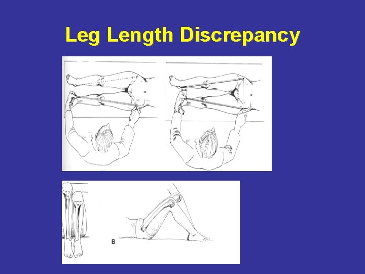 Leg Length Discrepancy 