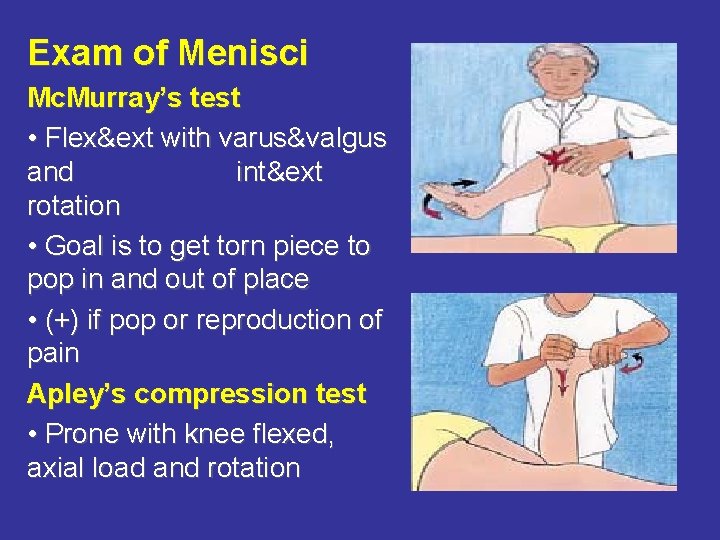 Exam of Menisci Mc. Murray’s test • Flex&ext with varus&valgus and int&ext rotation •