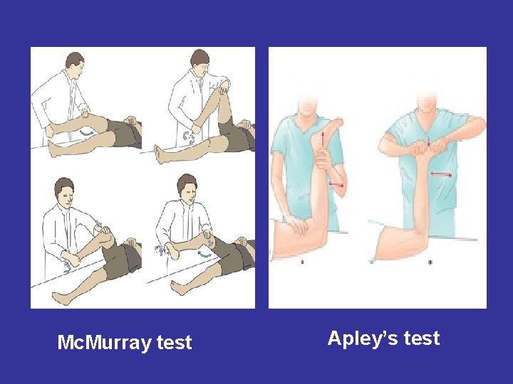  • Mc. Murray test Apley’s test 