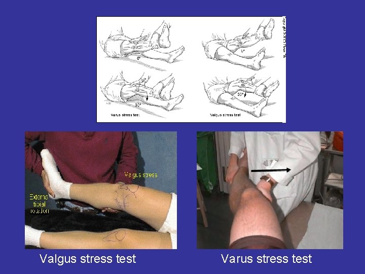 Valgus stress test Varus stress test 