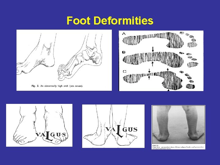 Foot Deformities 