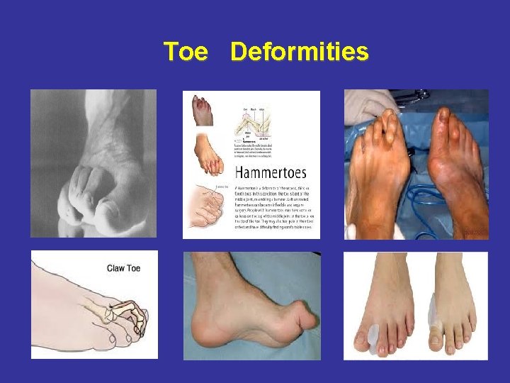 Toe Deformities 