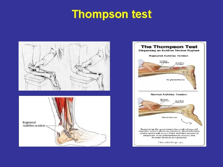 Thompson test 