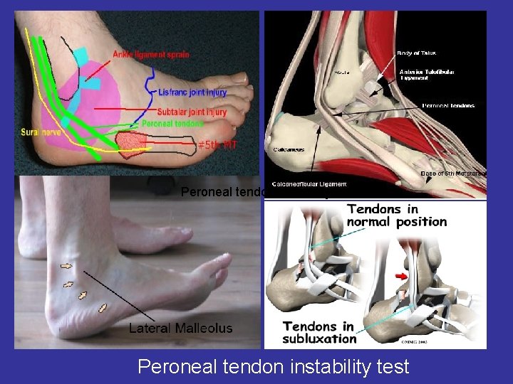 Peroneal tendon instability test 