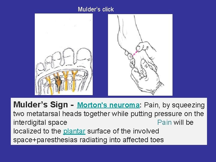 Mulder’s click Mulder’s Sign - Morton's neuroma: Pain, by squeezing two metatarsal heads together