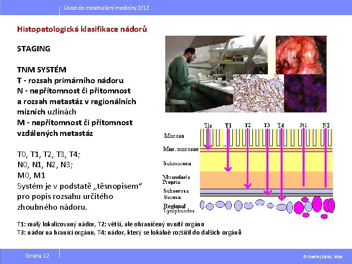 Úvod do molekulární medicíny 2/12 Histopatologická klasifikace nádorů STAGING TNM SYSTÉM T - rozsah