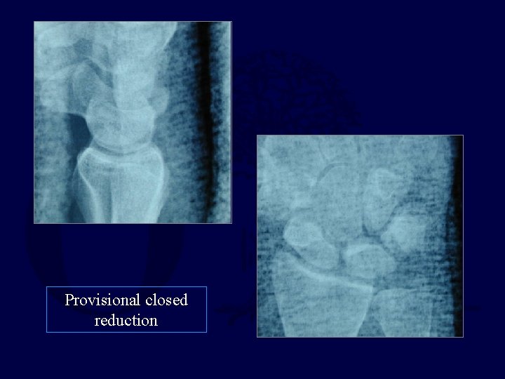 Provisional closed reduction 